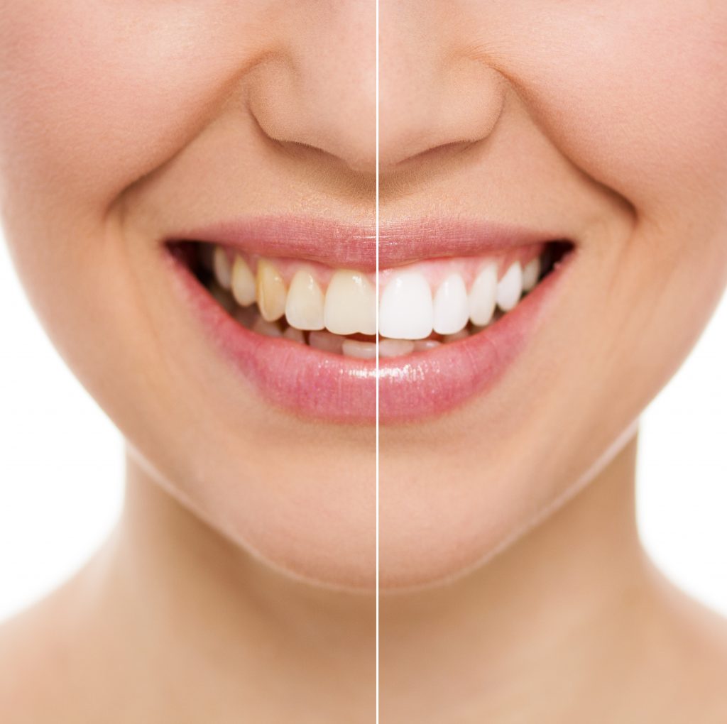 Opalescence: Whitening Smiles for 30 Years